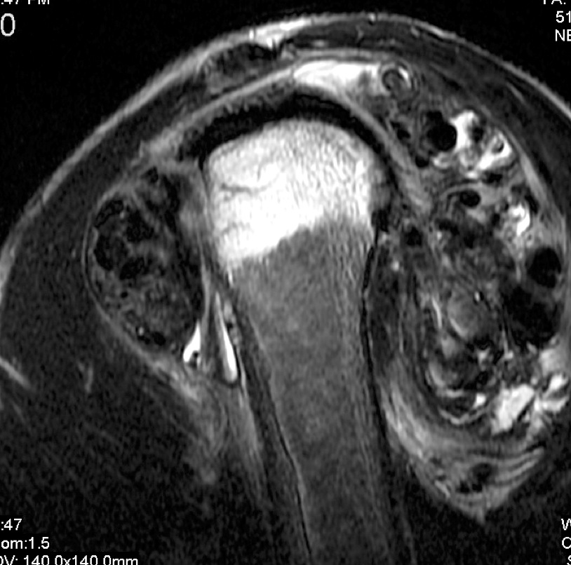 Figure 6 for case tumoral calcinosis ( RID5202 )